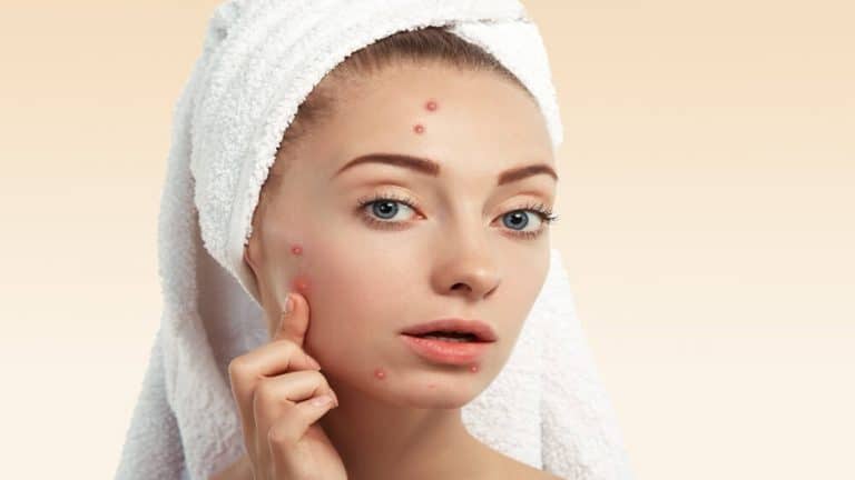 how to hide pimples without makeup